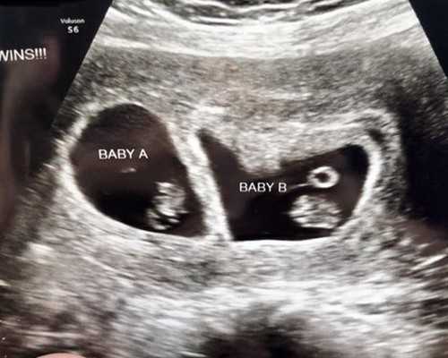 深圳国外代孕哪家好，孕期血压高究竟有多可怕