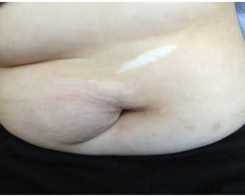 无精症怎么治疗？