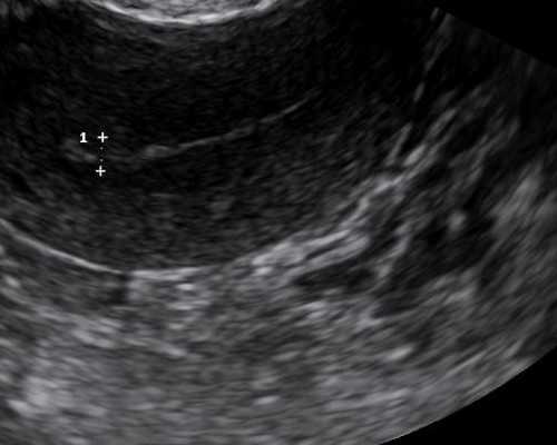 46岁做供卵试管成功率,57岁在公立三甲医院做供卵试管成功率有多少？
