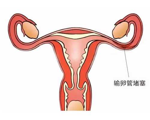 什么是产后积奶 产后积奶怎么办