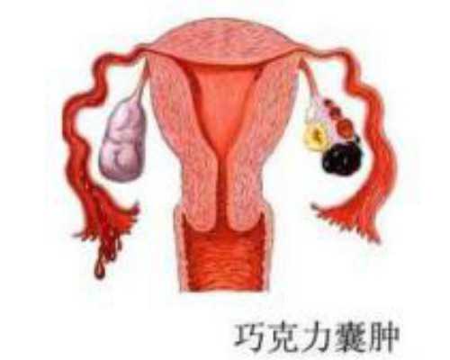 黔南州代孕_黔南州代育生孩子联系方式_卵巢癌的