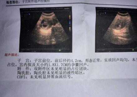 代孕怀双胞胎多少钱：孕妇缓解孕吐的几个小窍